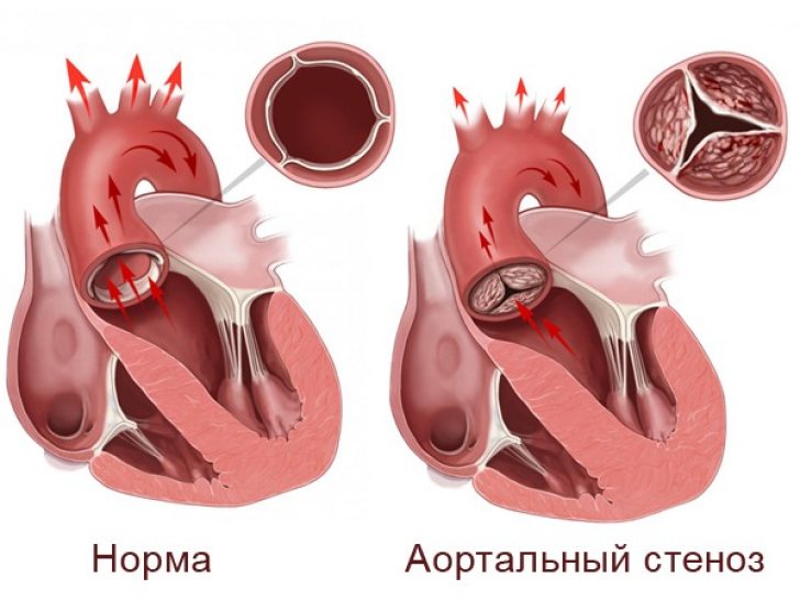 протезирование аортального клапана