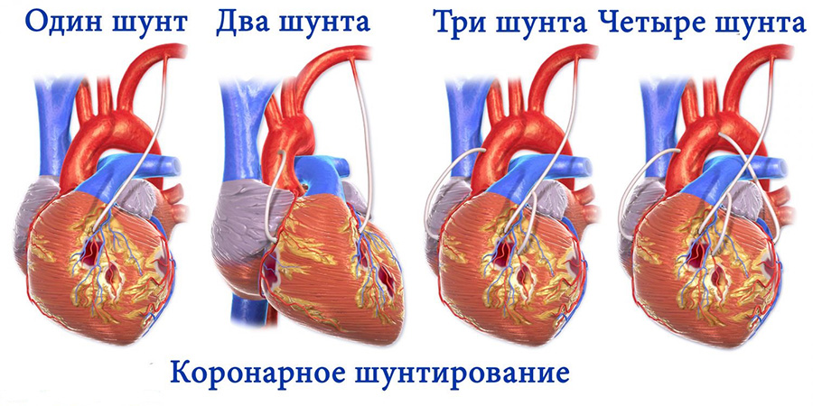 Шунтирование сосудов сердца при заболеваниях thumbnail
