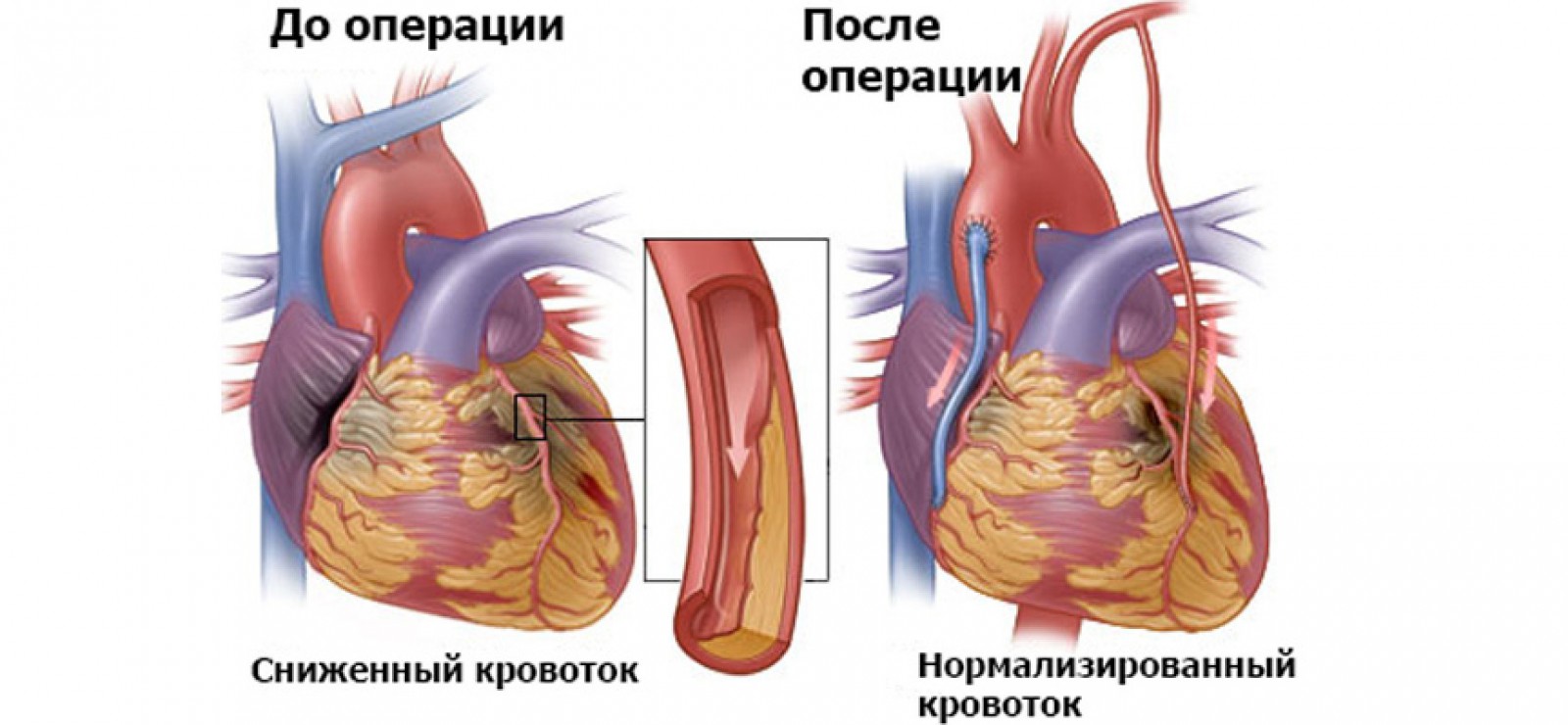 Шунтирование сосудов сердца при заболеваниях