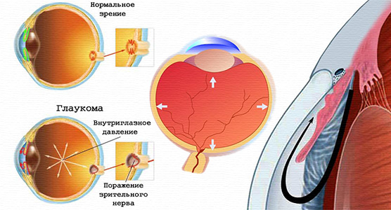 Центр лечения глаукомы в Москве thumbnail