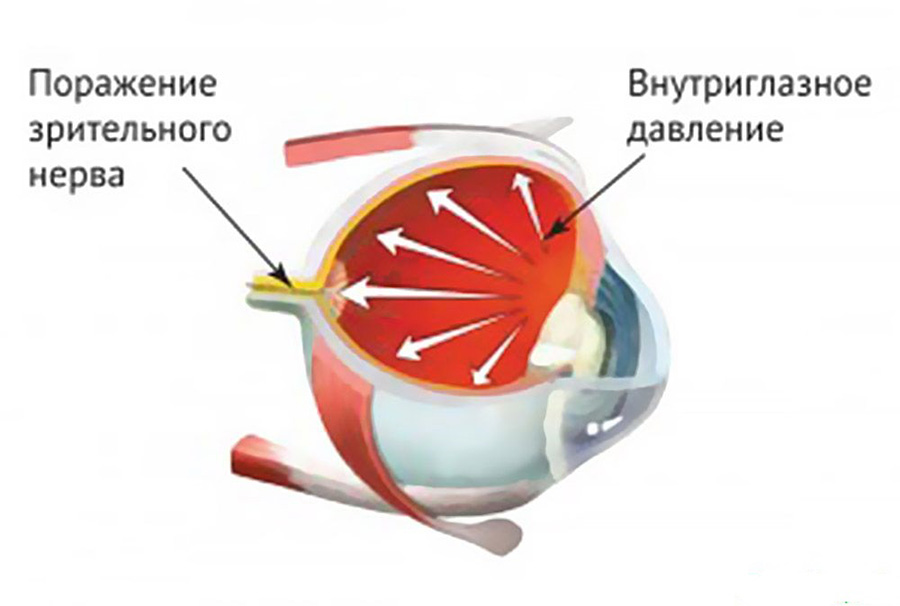Центр лечения глаукомы в Москве
