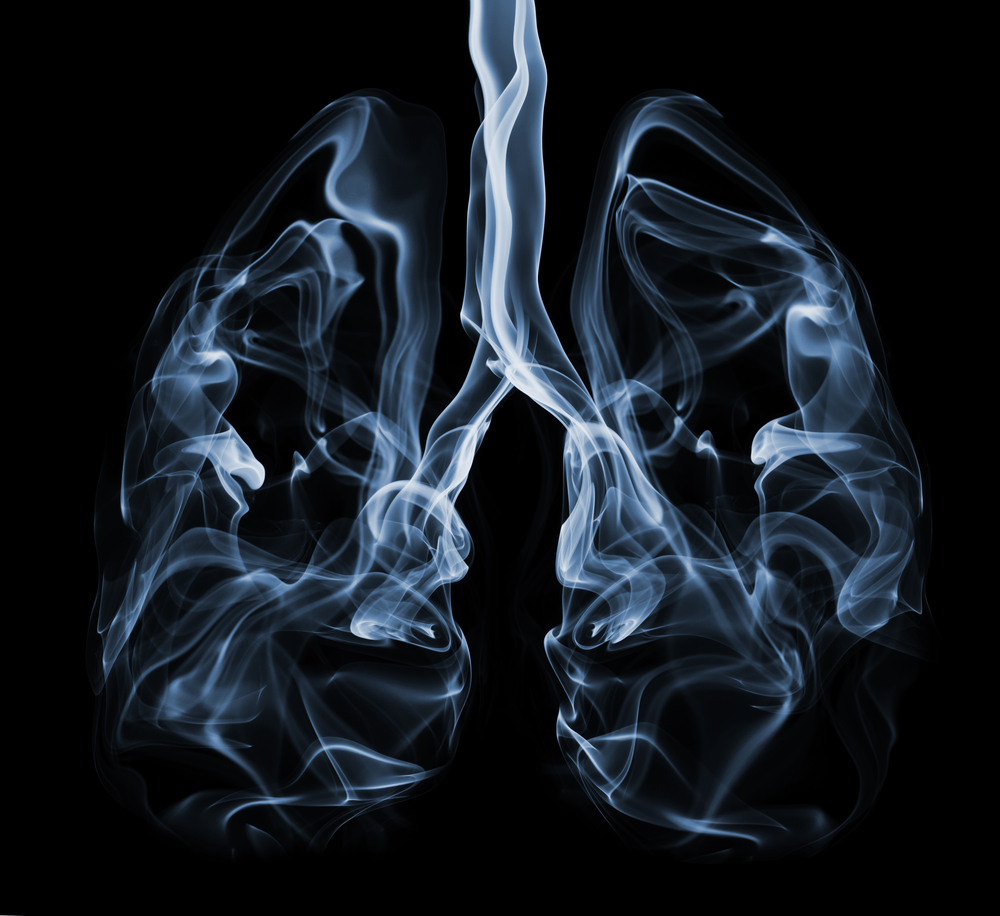 Плоскоклеточный рак легкого — результат курения и плохой экологии