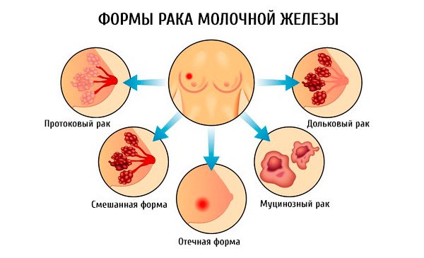 Разновидности рака молочной железы