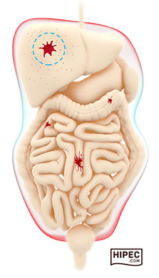 HIPEC-Peritoneal-Cancer-Illustration.jpg