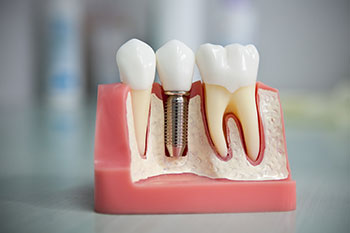 Имплантация зубов.jpg