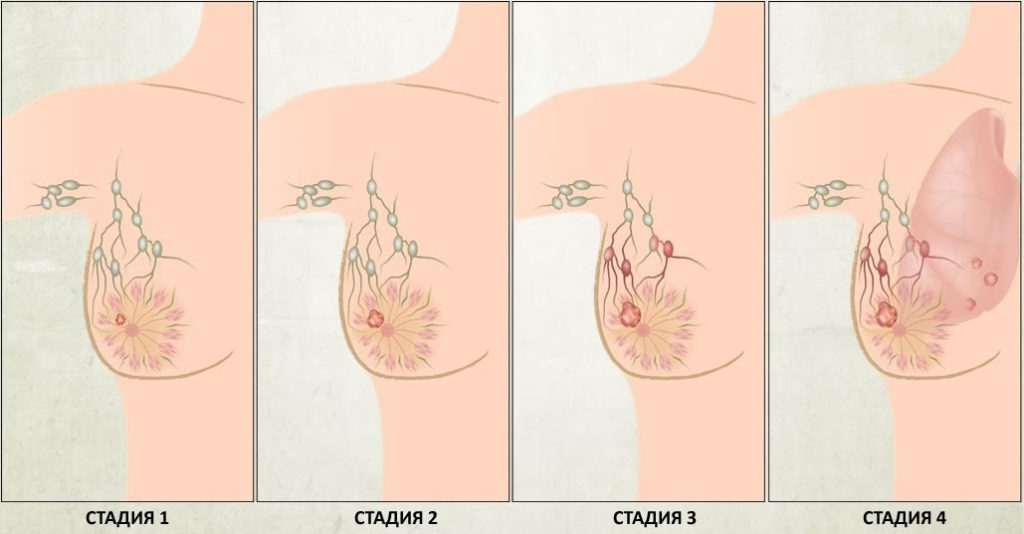 Рак груди на разных стадиях