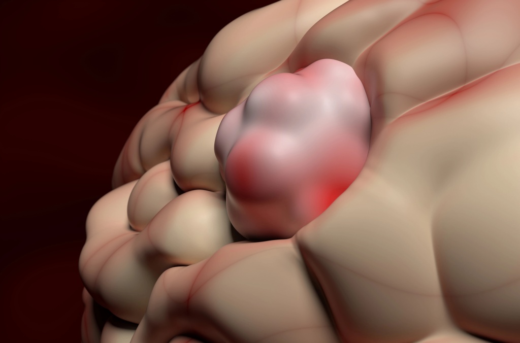 Глиома головного мозга — опухоль из глиальных клеток, 3D-визуализация