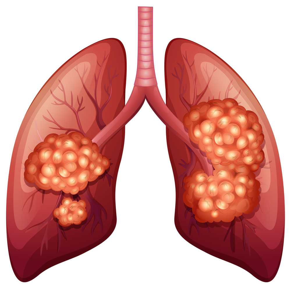 3 стадия рака лёгких
