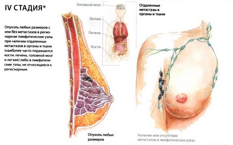 Рак груди 4 стадия
